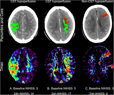 Corticospinal Tract Hypoperfusion Associated With Unexplained Early Neurological Deterioration After Intravenous Thrombolysis